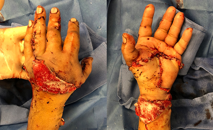 Reimplante de mão após amputação transmetacarpal e laceração do antebraço. — BTM aplicado
