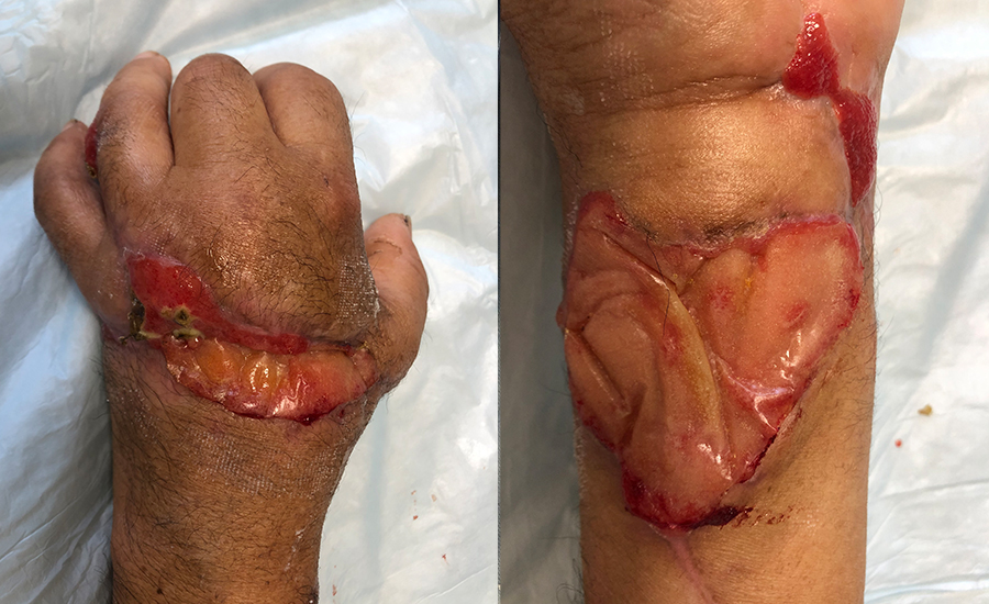 Reimplante de mão após amputação transmetacarpal e laceração do antebraço. — Integrado no dia 61