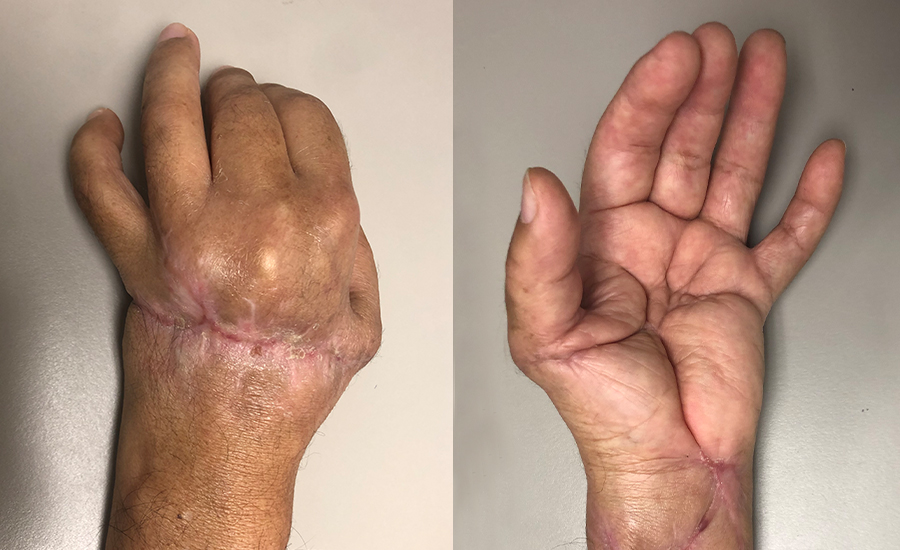 Reimplante de mão após amputação transmetacarpal e laceração do antebraço. — 5 meses após a cirurgia