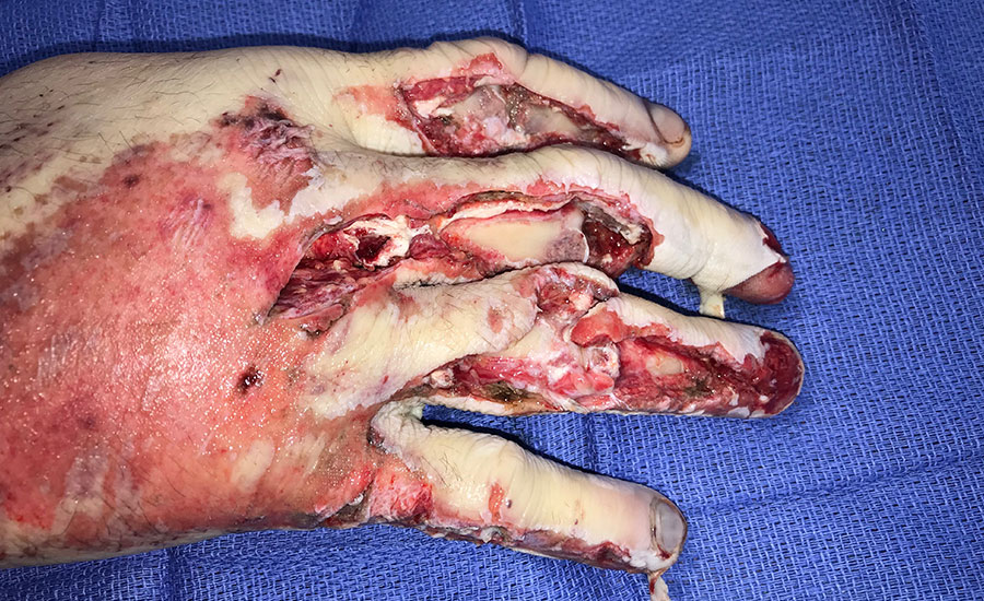 Reepitelização de trauma na mão após aplicação de BTM — Antes