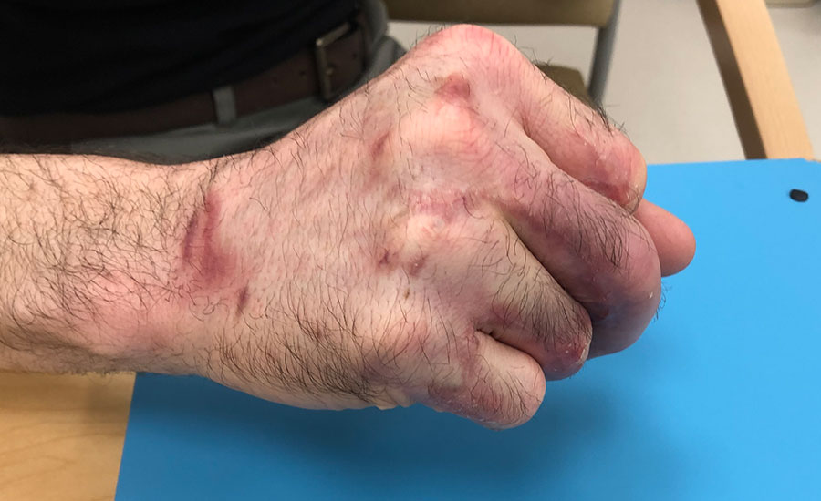 Reepitelização de trauma na mão após aplicação de BTM — Dia 82