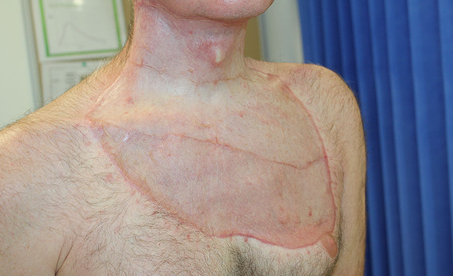 Grande ferida complexa na região anterior do pescoço e tórax após infecção por fasciite necrosante. — 3 meses após a enxertia