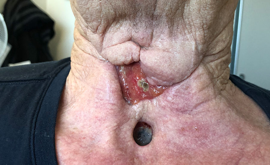 Fístula salivar crônica que não pôde ser fechada por 75 dias. — Antes